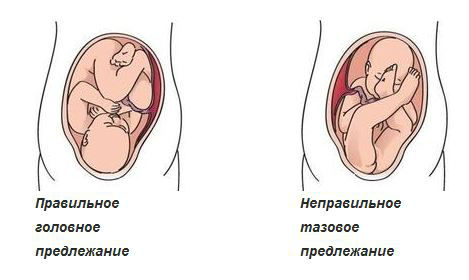 Дисплазия тазобедренных суставов у новорожденных